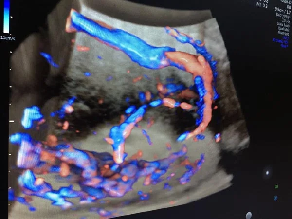 Ultrasound