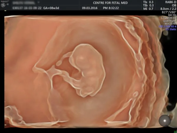 Ultrasound