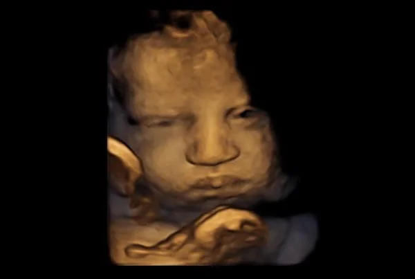 Ultrasound