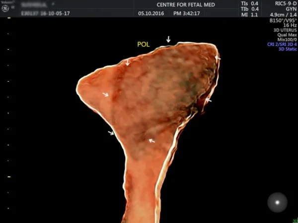 Ultrasound
