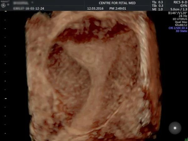 Ultrasound
