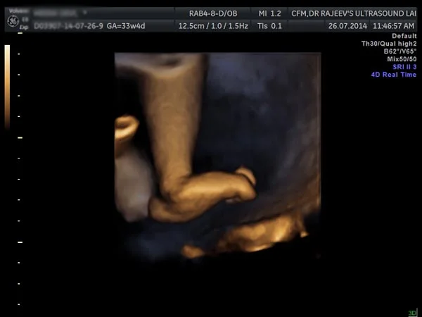 Ultrasound