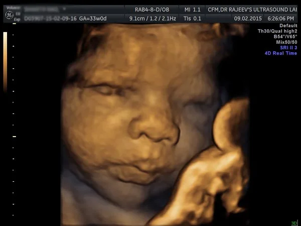 Ultrasound