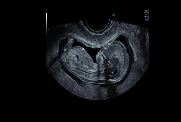 Ultrasound