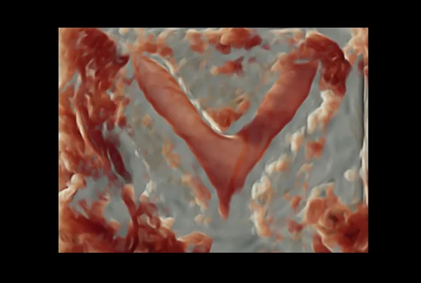 Ultrasound