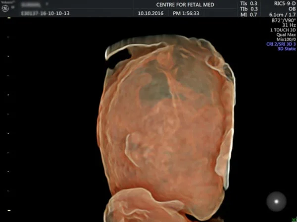 Ultrasound