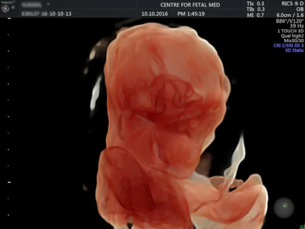 Ultrasound