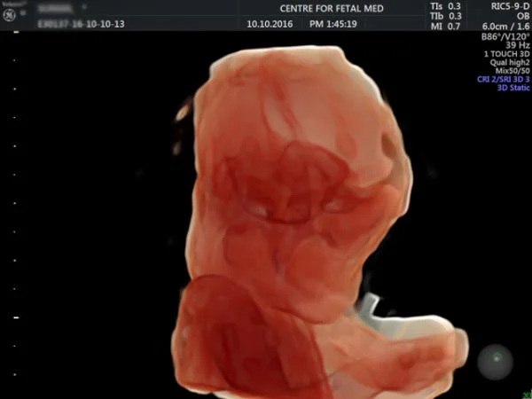 Ultrasound