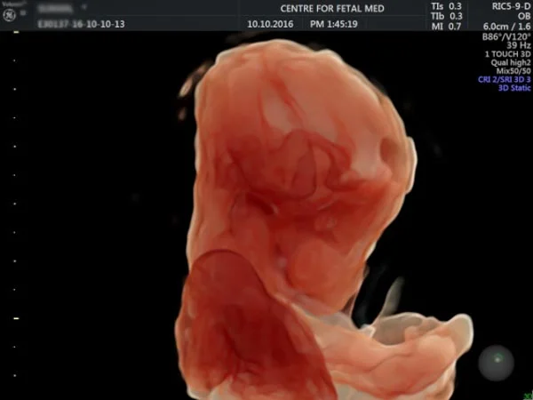 Ultrasound