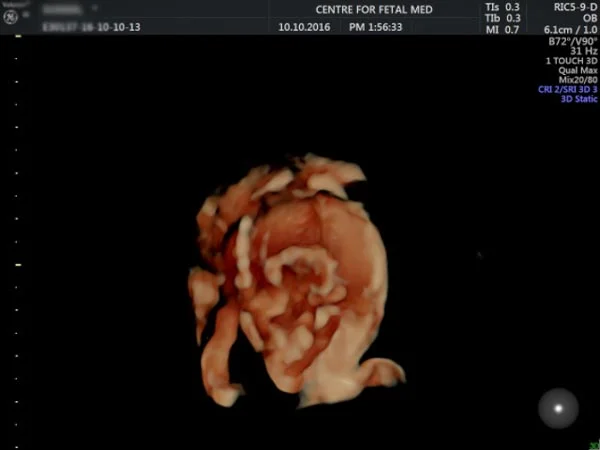 Ultrasound