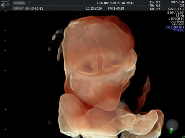 Ultrasound