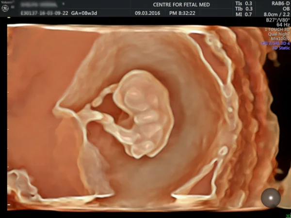 Ultrasound