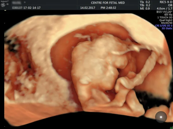 Ultrasound