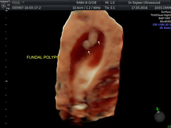 Ultrasound