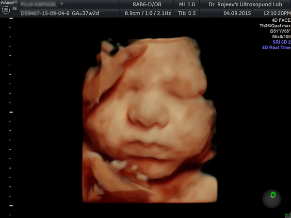 Ultrasound
