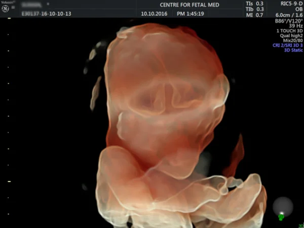 Ultrasound