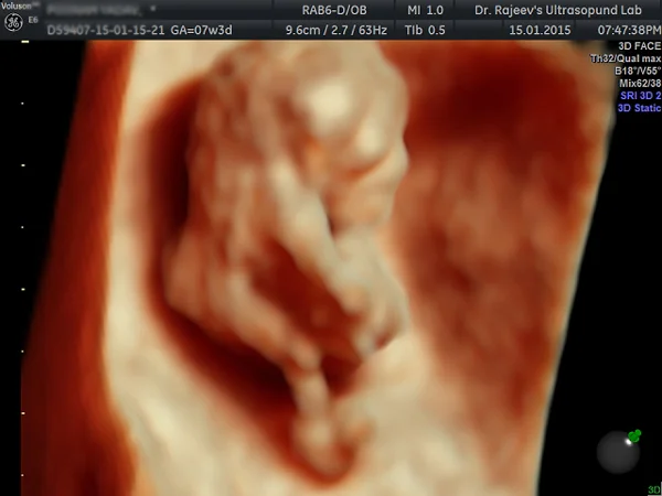 Ultrasound