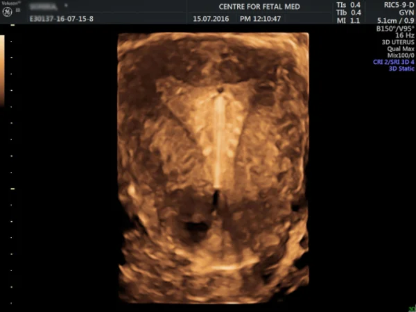 Ultrasound