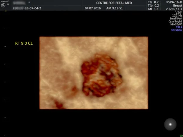 Ultrasound