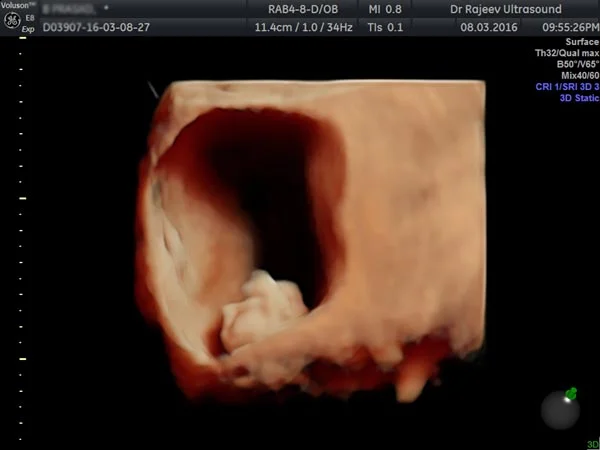 Ultrasound