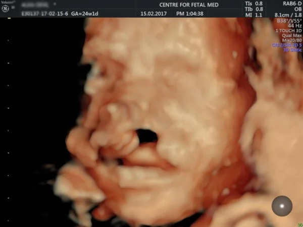 Ultrasound