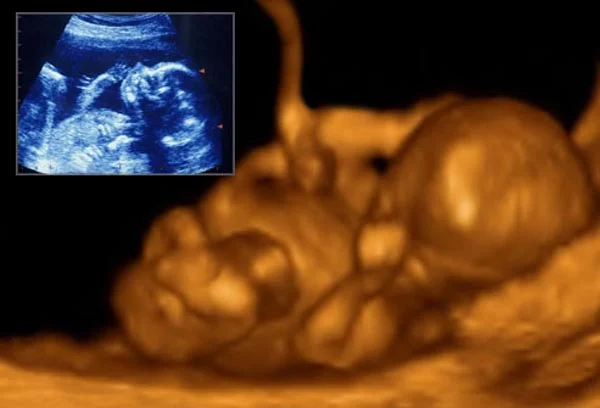 Ultrasound
