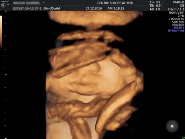Ultrasound