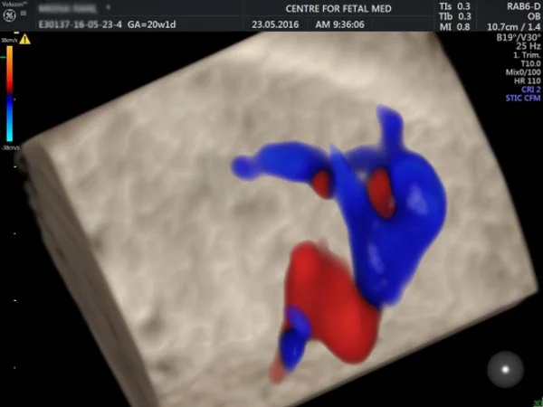 Ultrasound