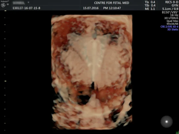 Ultrasound