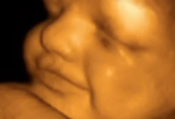 Ultrasound