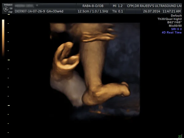 Ultrasound