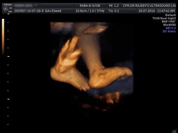 Ultrasound