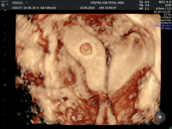 Ultrasound