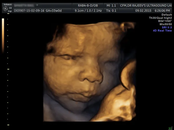 Ultrasound