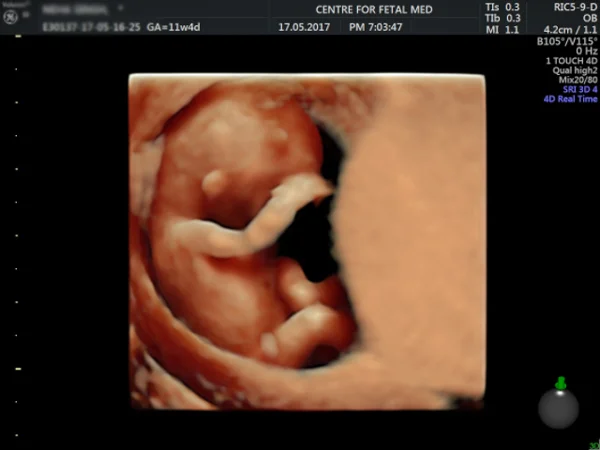 Ultrasound