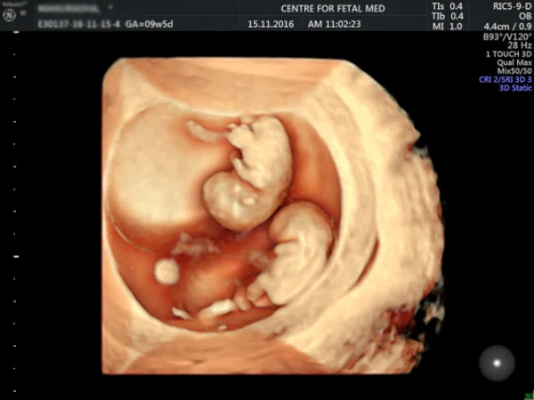 Ultrasound