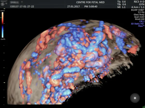 Ultrasound