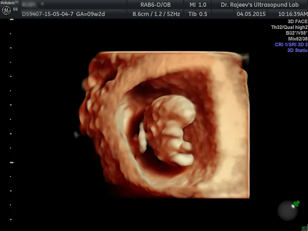 Ultrasound