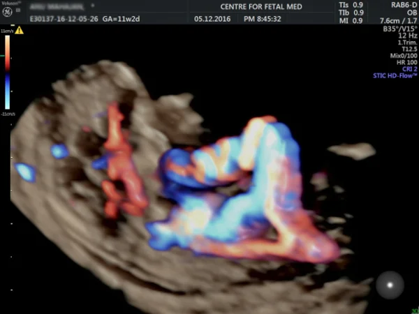 Ultrasound