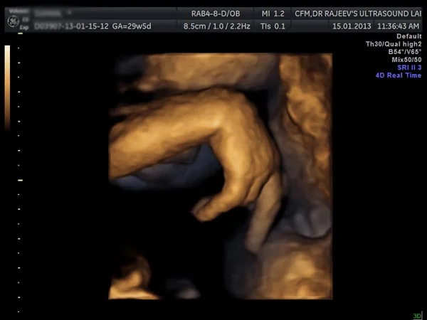 3D - 4D Ultrasound