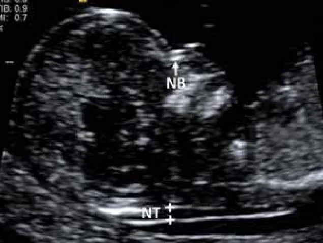 NT NB Scan	